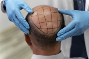 popularity-of-hair-transplants